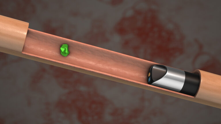 Ενδοσκοπική Αντιμετώπιση Λίθου