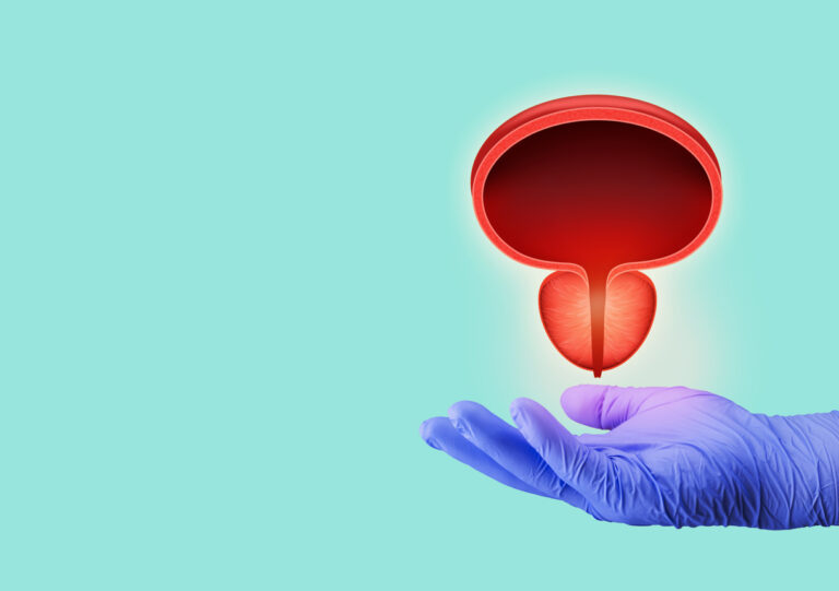 Καρκίνος Ουροδόχου Κύστης – Θηλώματα