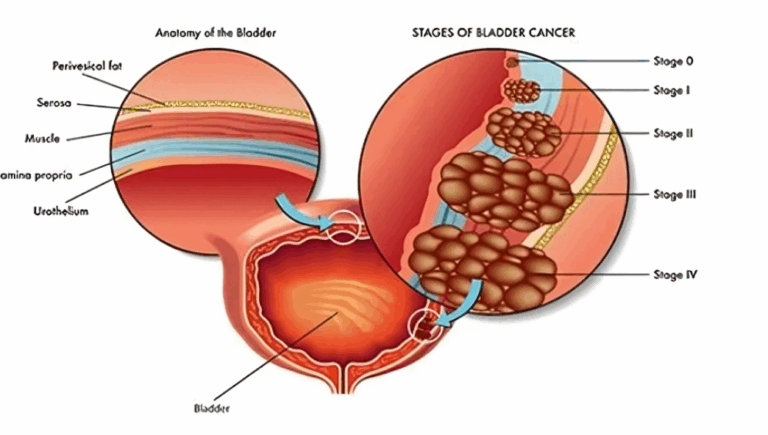 Χειρουργική Αντιμετώπιση Θηλώματος